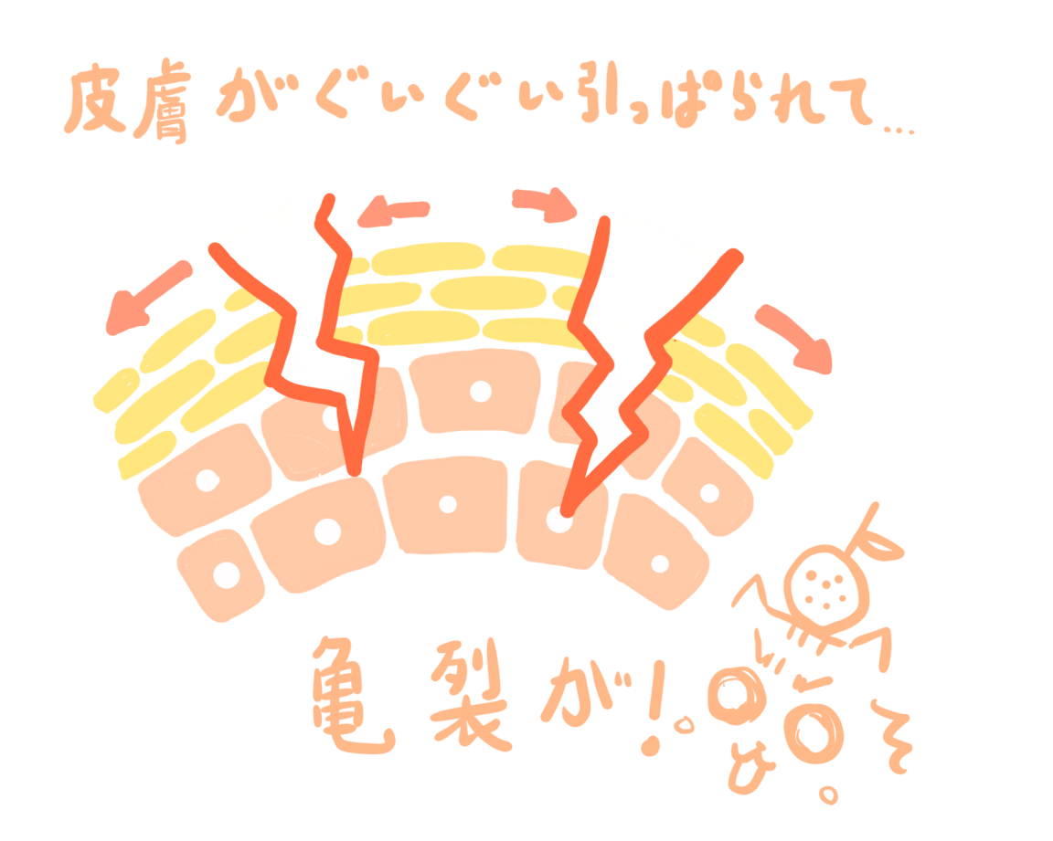 妊娠線